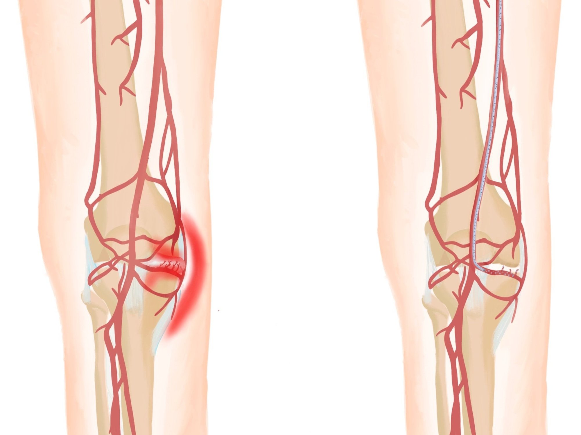 Genicular Artery Embolisation